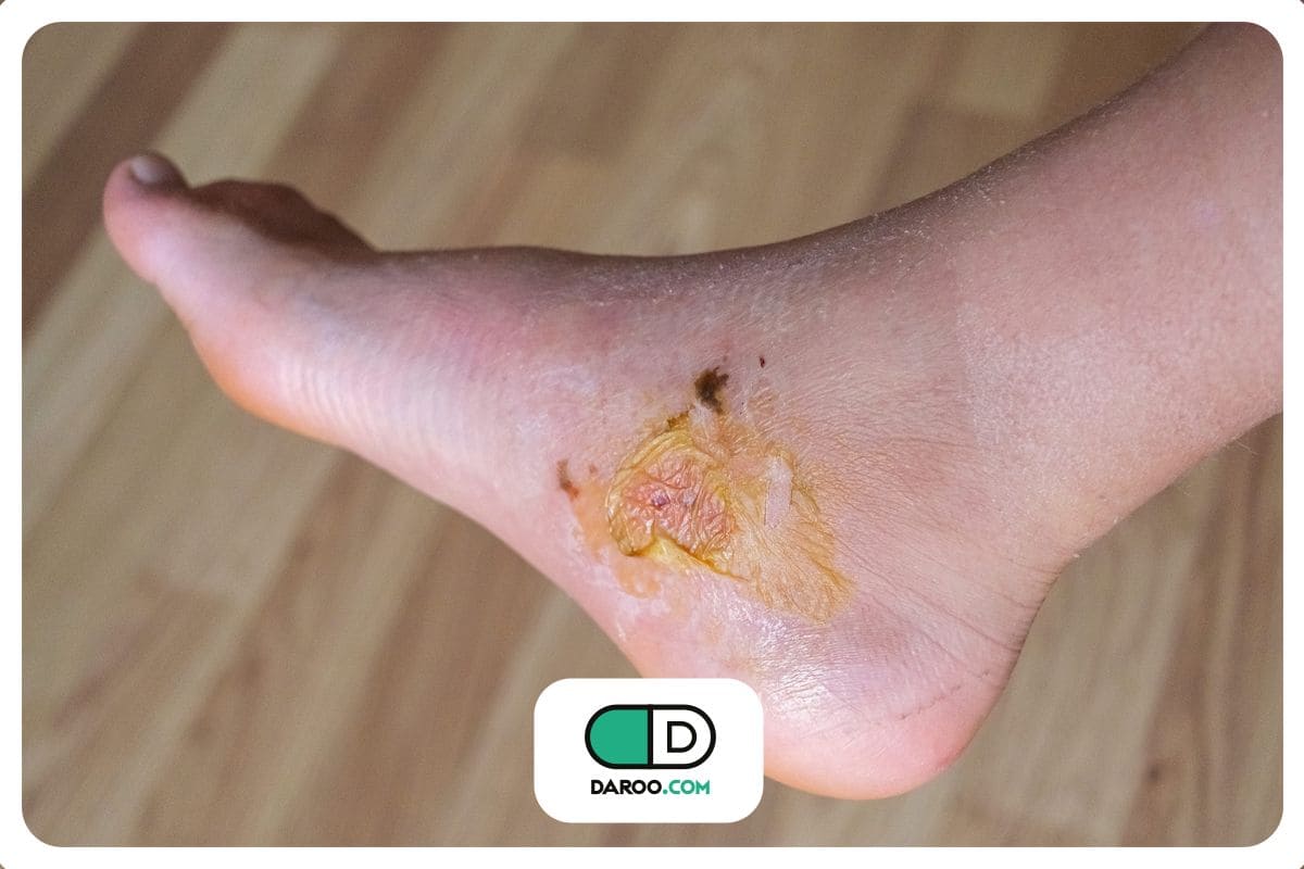 علائم و نشانه‌های اولیه زخم پای دیابتی