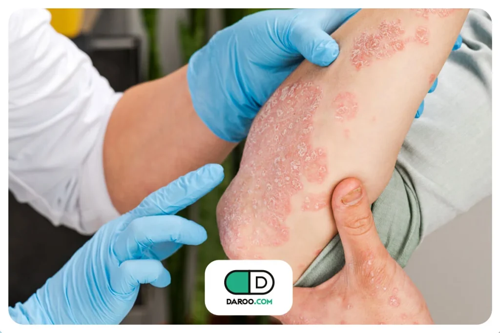 راه جدیدی برای بیماری پسوریازیس کشف شد!