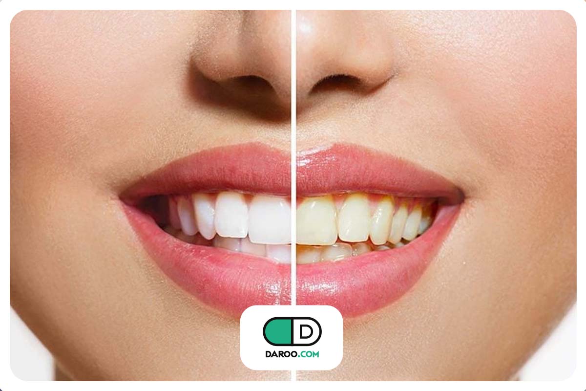 غذاهای مفید برای جلوگیری از پوسیدگی دندان