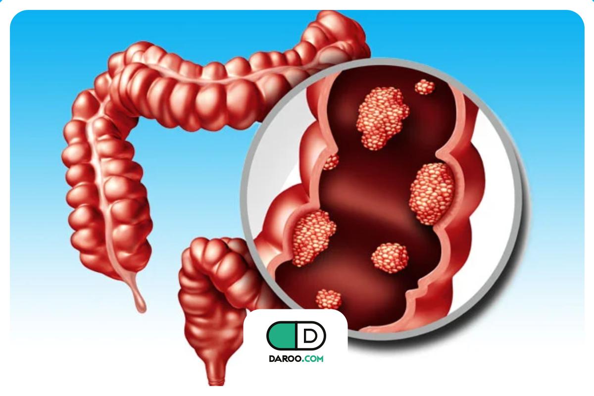 شیوع بالای سرطان روده بزرگ در ایران