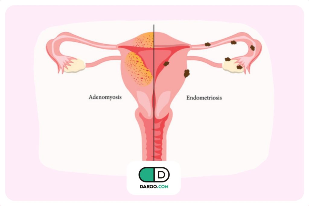 سابقه بیماری آندومتریوز در بسیاری از زنان نابارور