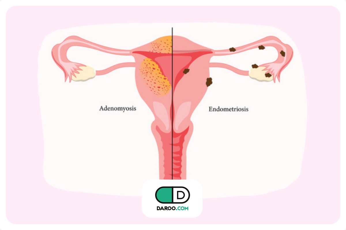 سابقه بیماری آندومتریوز در بسیاری از زنان نابارور