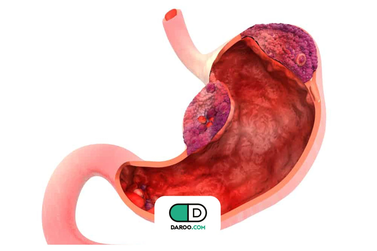 طول عمر سرطان معده بدخیم چقدر است؟