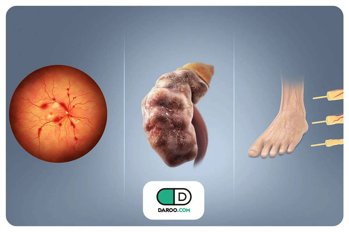 عوارض میکروواسکولار دیابت چیست؟