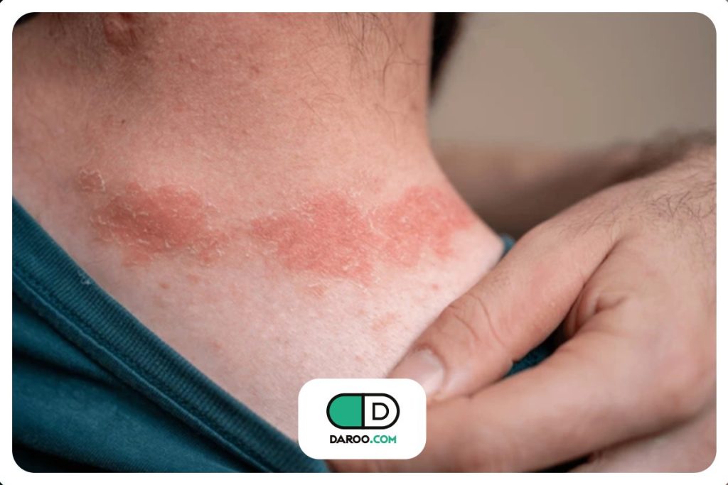 درمان دارویی جدید برای پسوریازیس