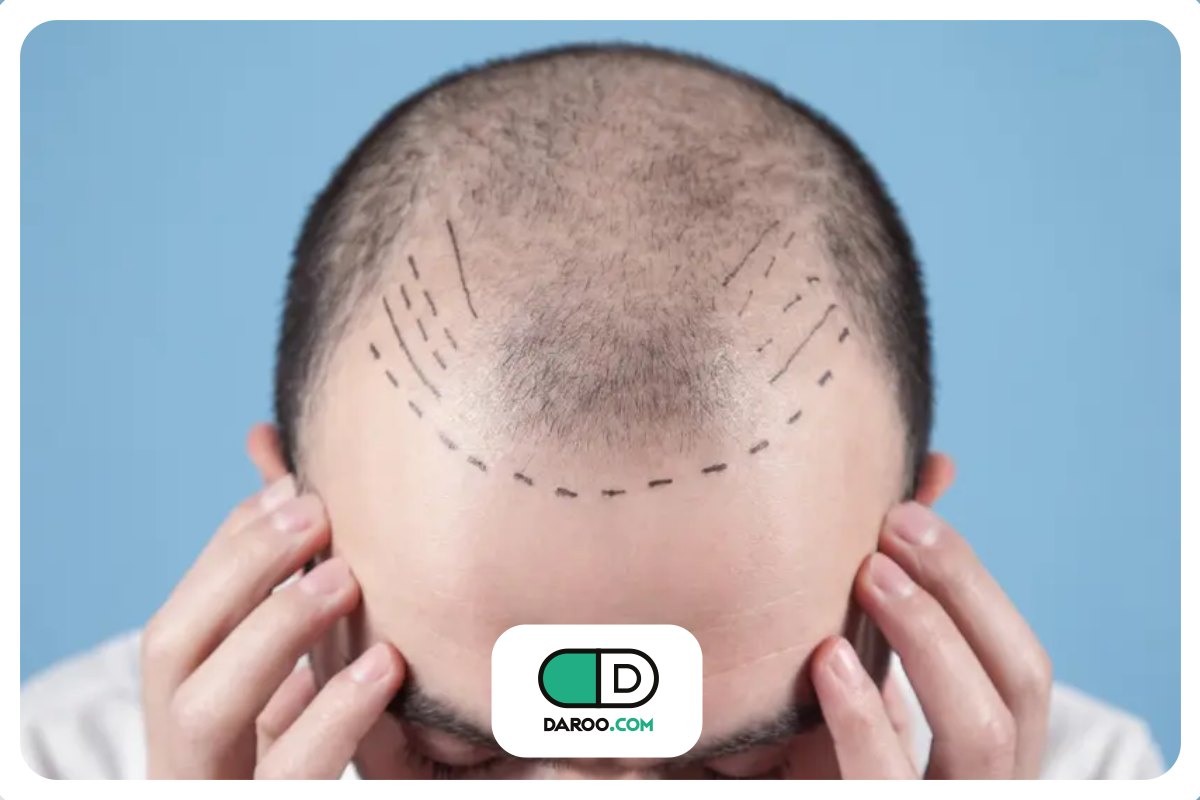 آیا کره جنوبی درمان ریزش مو را تحت پوشش بیمه قرار میدهد؟