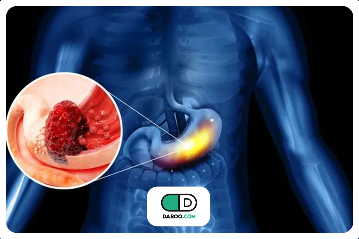 سرطان معده چیست؟ علائم و راه های پیشگیری