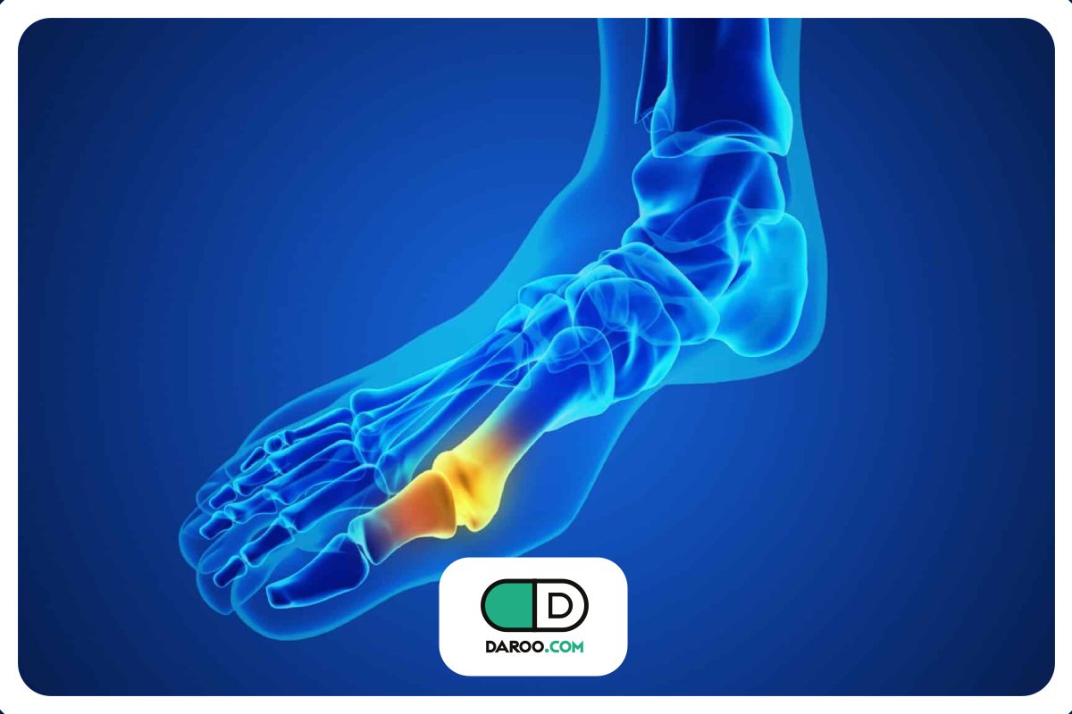 ۶ راهکار برای رفع تجمع کریستالهای اورات در مفصل