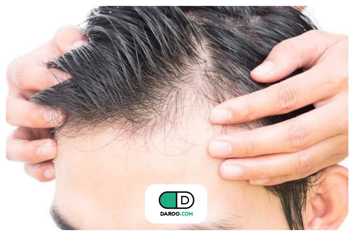 شایعترین انواع ریزش مو در مردان