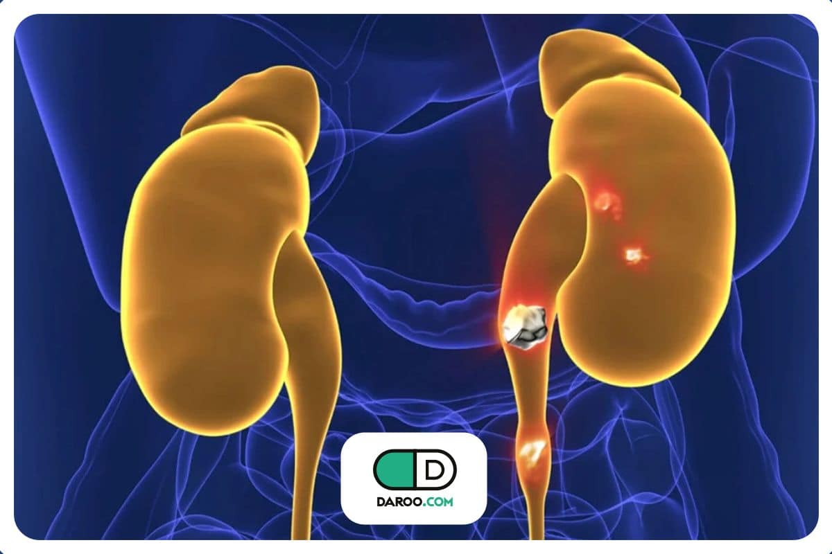 کشف تازه: سنگ کلیه ممکن است نتیجه تجمع باکتری‌ها باشد